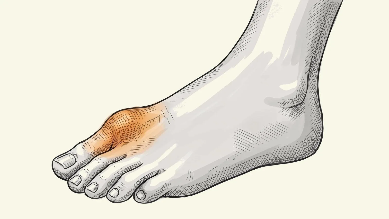 Illustration of a bare foot with a swollen big toe joint glowing orange