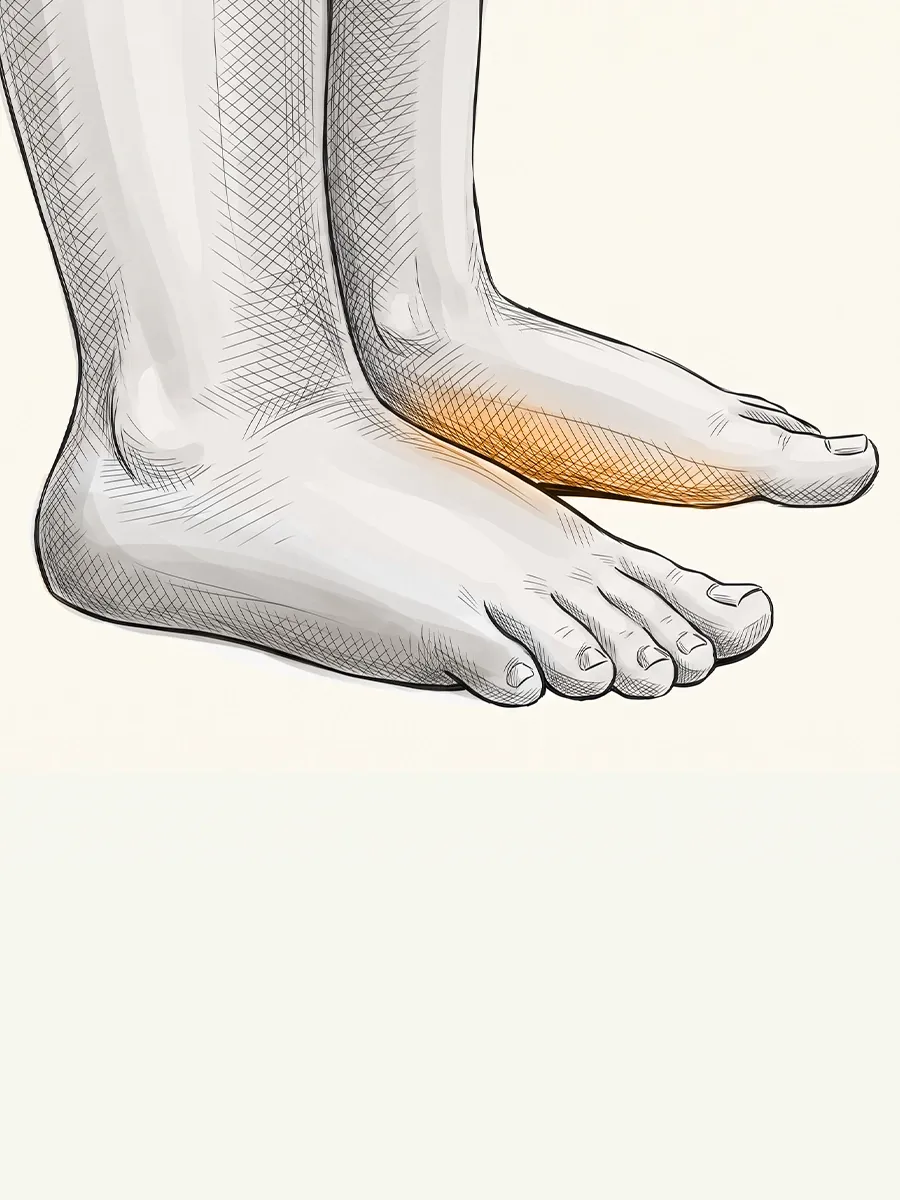 Illustration of a child's feet, with the inside of the arch marked where it has flattened