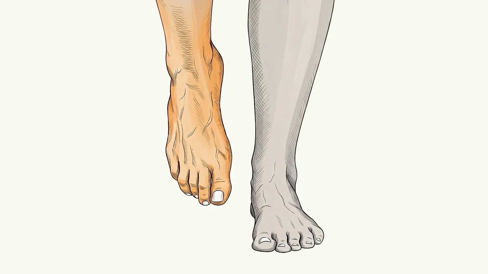 Illustration of a foot dragging near the ground during a step, showing foot drop