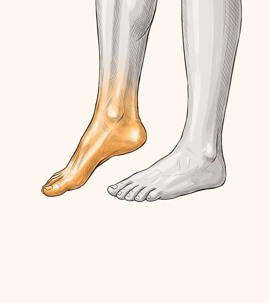 Illustration of a foot dropping, the toes hanging down and unable to clear the ground, beside an unaffected foot