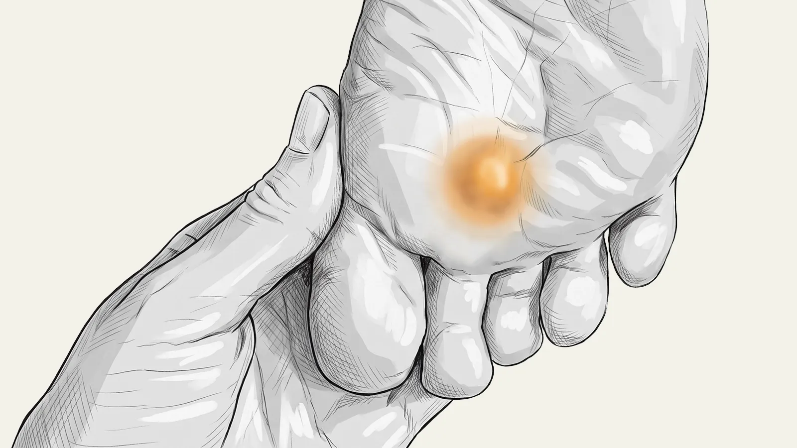 Illustration of a drifted second toe with swelling at its base