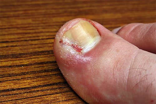 Permanently Fixing Ingrown Toenails in Under An Hour - Here's How!