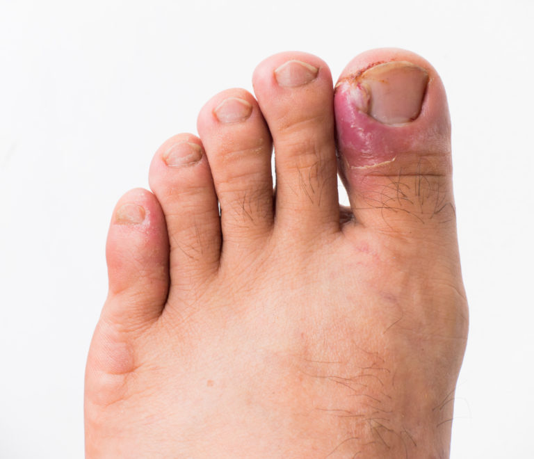 Ingrown Toe Nail Treatment | Qureshy Foot & Orthotic Clinic | Chiropodist  Oshawa