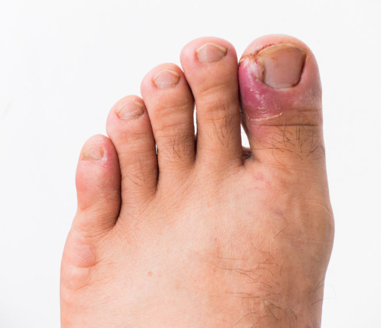 Ingrown toenail non-invasive treatment - The Foot Group