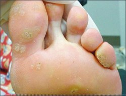 verruca, plantar warts on the foot