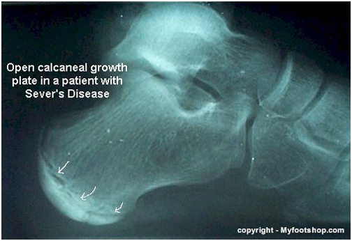 inflammation of growth plate in foot