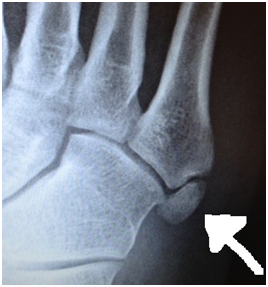 foot growth plate pain