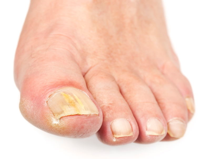 Nail Fungal Infections | U.S. Dermatology Partners