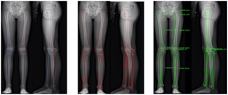 Xrays measuring leg length.