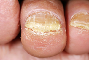 How to Cut Thick Toenails and Make Toenails Thin