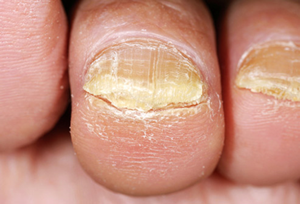 Beau's Lines On Nails: Causes, Symptoms, and Solutions