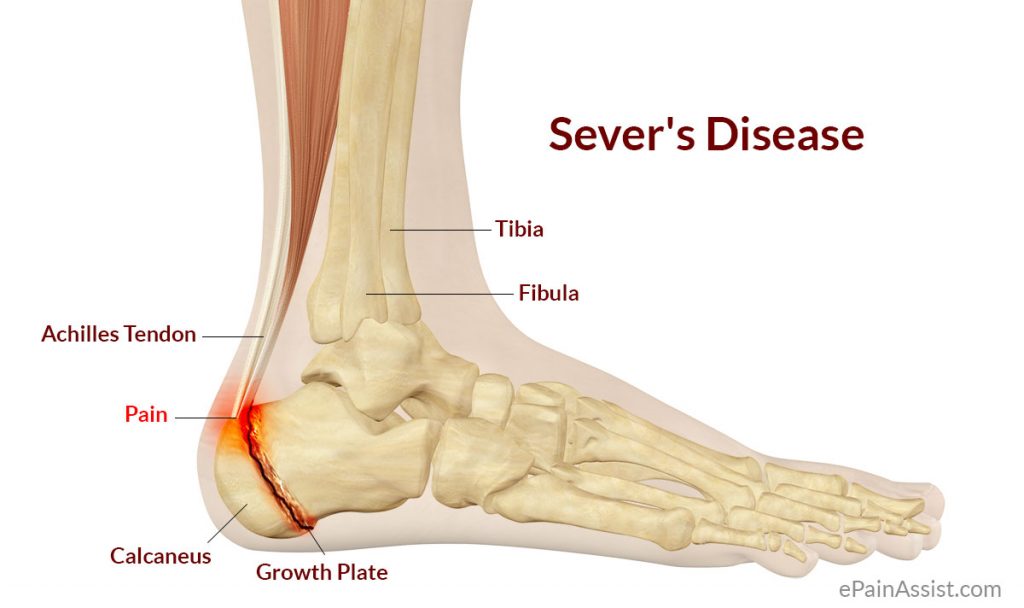 Sever-Disease