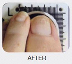 Toenail After Laser Treatment