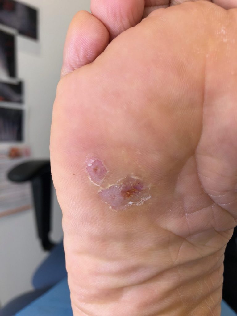Plantar Warts (Verrucae) How to finally get rid of those painful