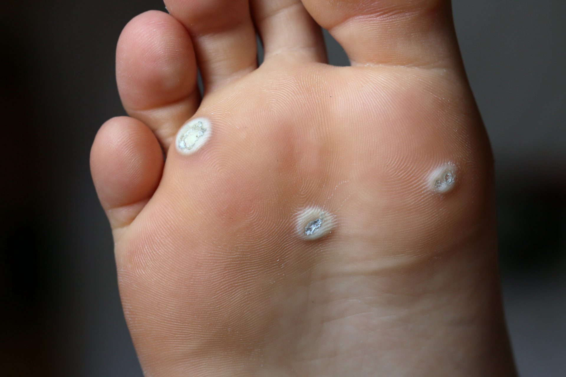Plantar Wart For 15 Years At Mario Anderson Blog