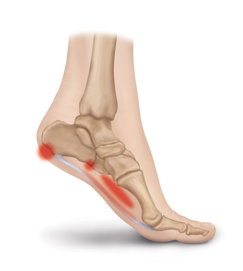 Plantar Fasciitis and Multiple Sclerosis: Understanding Foot Pain | MyMSTeam