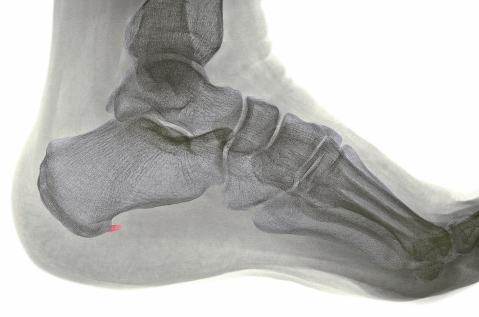 Ask a General Surgeon Online for PF & HEEL SPUR