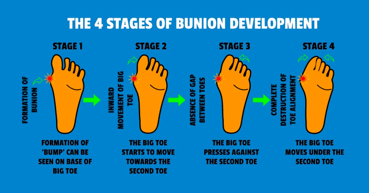 Bunions
