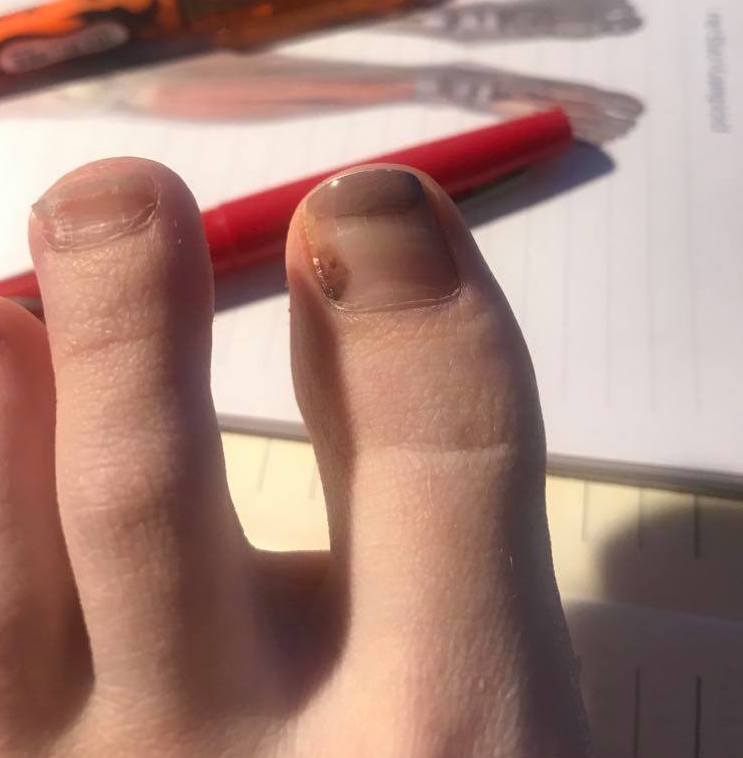 Psoriasis in the fingernails and toenails