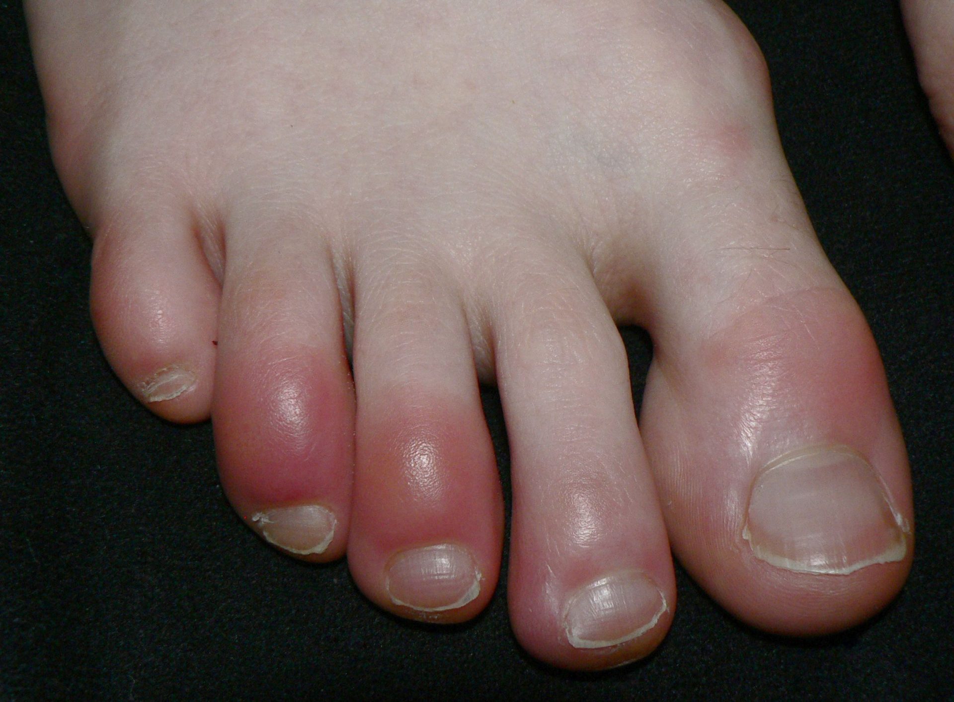 Finding relief from calluses and corns - Harvard Health