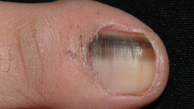 The Brown Spot On Your Nail: A Melanoma Or A Simple Bleed?