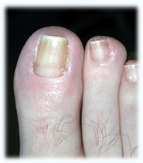 HOW TO SAFELY REMOVE A DAMAGED TOENAIL