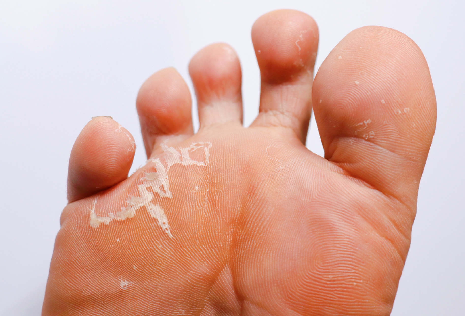 Sally's Foot Clinic - Athlete's foot (tinea pedis) is a fungal