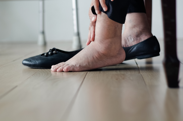 Why Do Feet Swell 