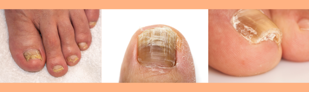 How Can I Stop My Toenails From Growing Thicker?