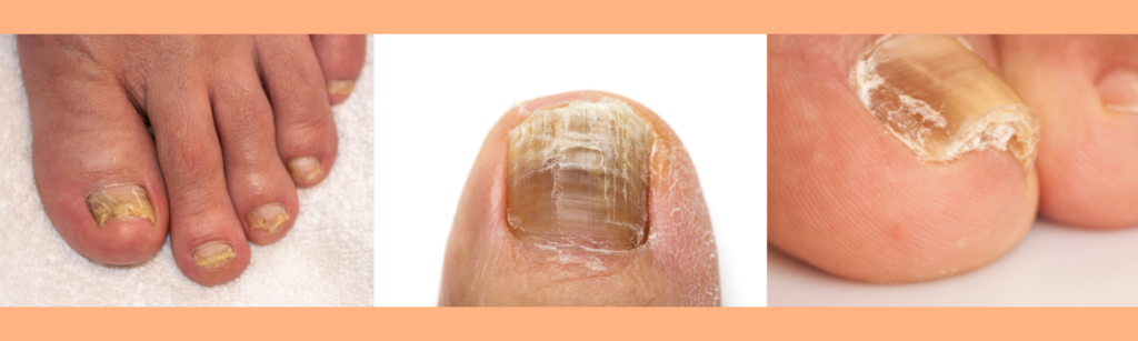 Why Is My Toenail Growing Thick & Discoloured? – merivale-podiatry