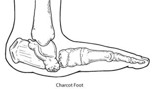 detailed drawing of a foot foot with charcot foot 