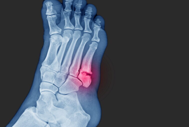 X-ray of foot highlighting a jones avulsion fracture 