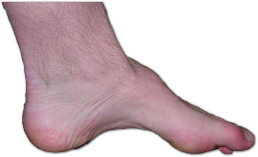 Photo of a foot with Charcot Marie Tooth Disease