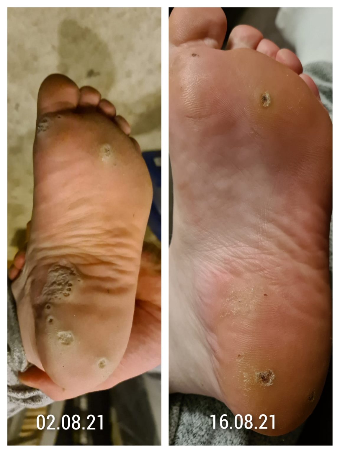 Case Study Successfully Treating A Foot Covered In Plantar Warts
