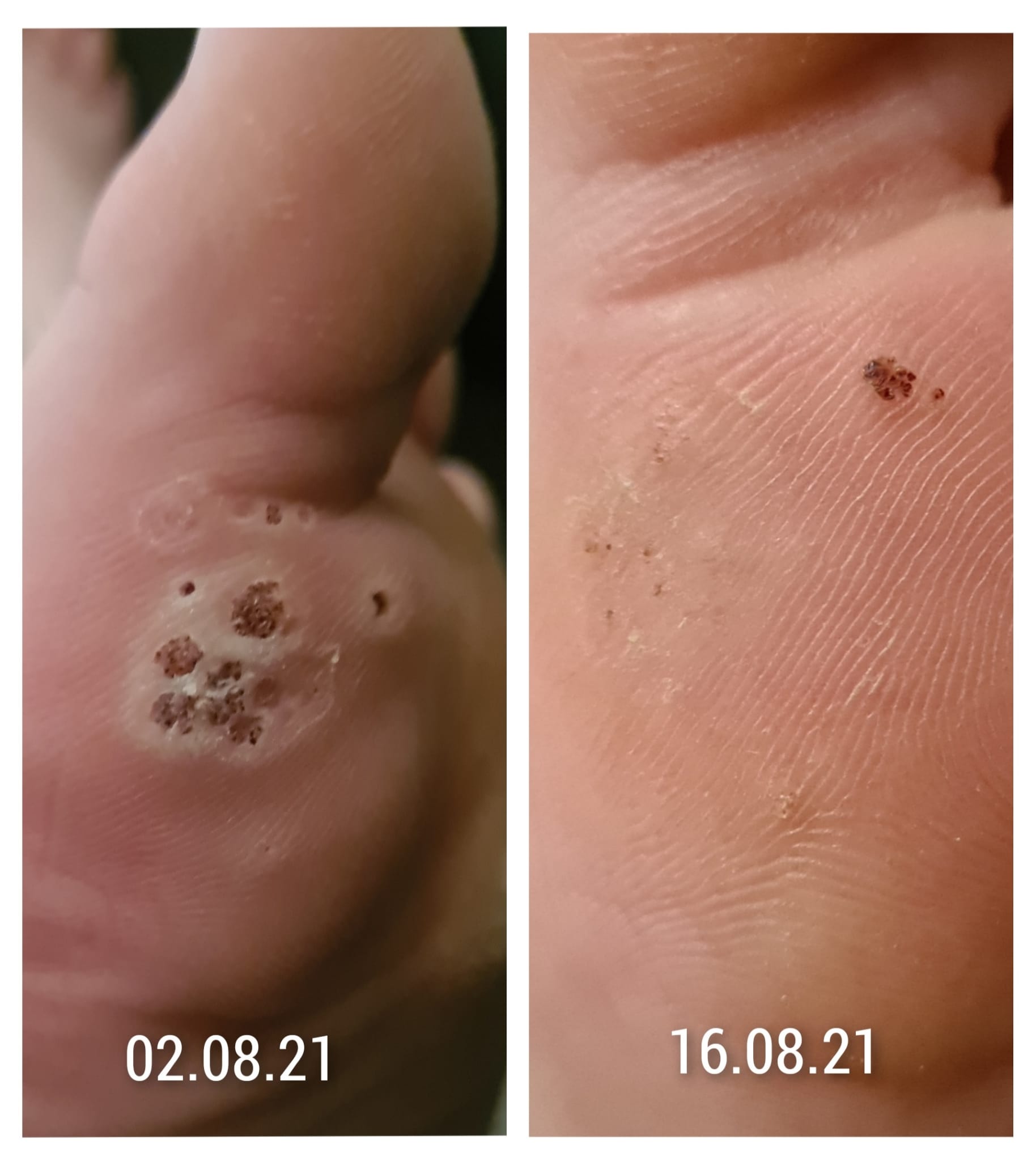 Case Study Successfully Treating A Foot Covered In Plantar Warts