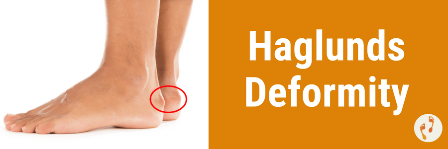 Haglund's syndrome, achilles tendon surgery | Joint-surgeon.com