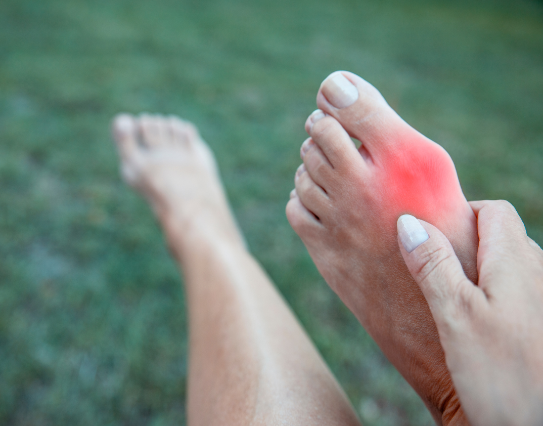 Big Toe Pain: Five Things That Are Making Your Bunion Worse